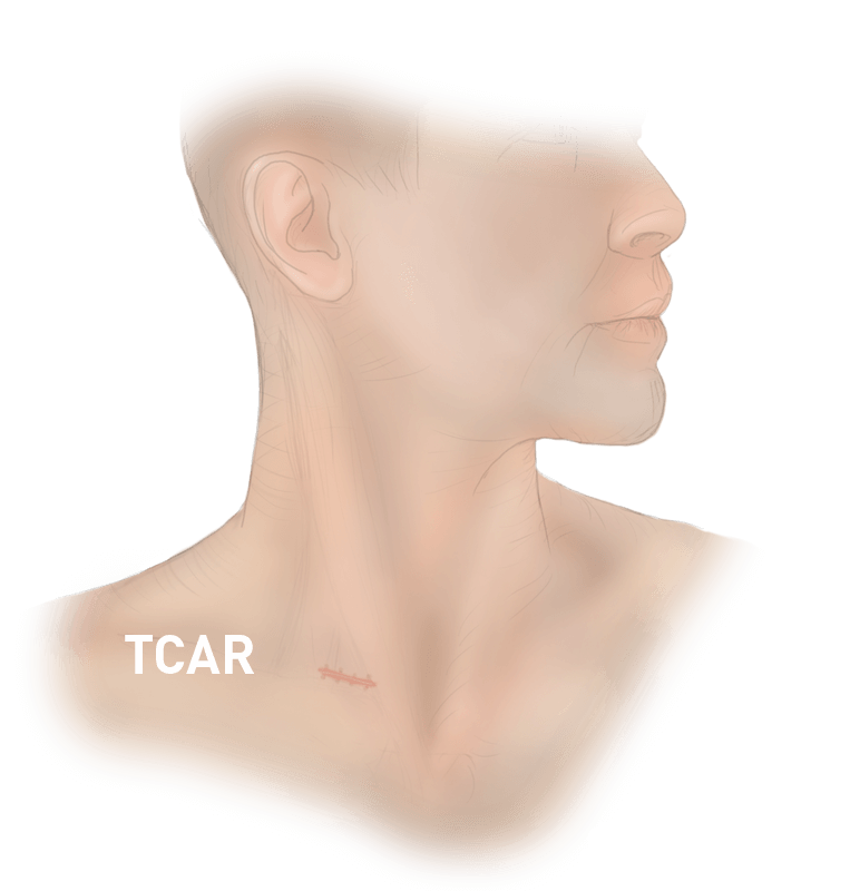 Arteries In Neck Clogged Endarterectomy Western New York Urology